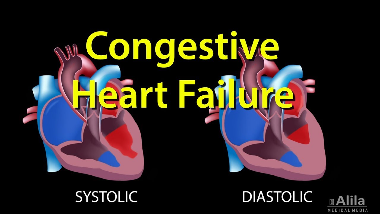 Congestive Heart Failure: Left-sided vs Right-sided, Systolic vs Diastolic, Animation.