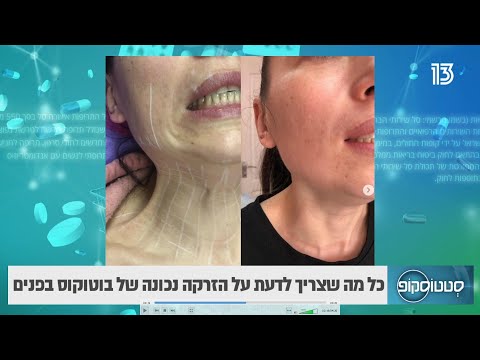 טכניקה ייחודית להזרקת בוטוקס בחלק התחתון של הפנים