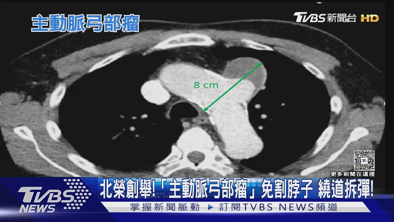 三高.抽菸族注意!主動脈弓部瘤恐奪命 北榮推「新技術」救回多命