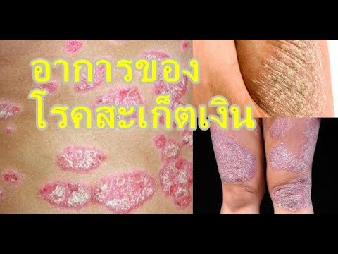 ครีมกลาก streptoderma กลาก Palmar-ฝ่าเท้าที่หายฟอรั่ม