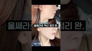 에이비 2SPT 울쎄라 리얼 후기