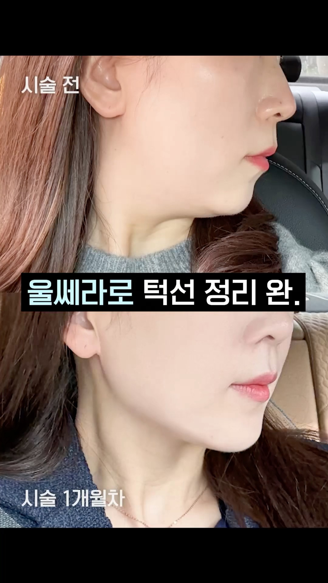 에이비 2SPT 울쎄라 리얼 후기