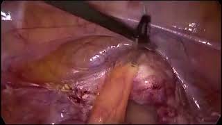 Versa Lifter Needle - GYN Applications