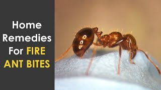 Home Remedies To Get Rid Of Fire Ant Bites