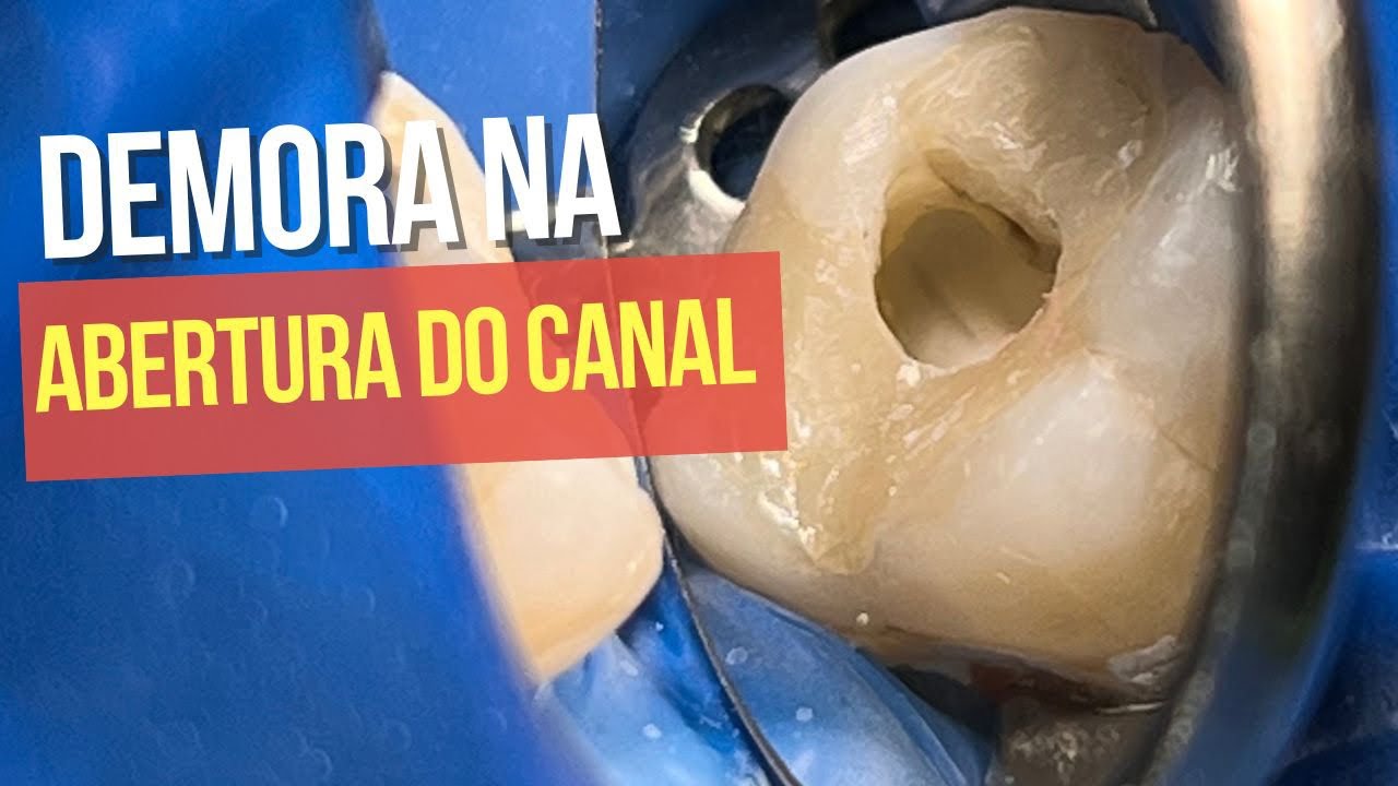 3 PONTOS QUE TE ATRASAM NO ACESSO AO CANAL - Endolovers