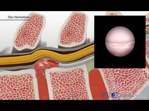EEN 수술법이란? 천추 내시경 레이저 감압술(SELD)
