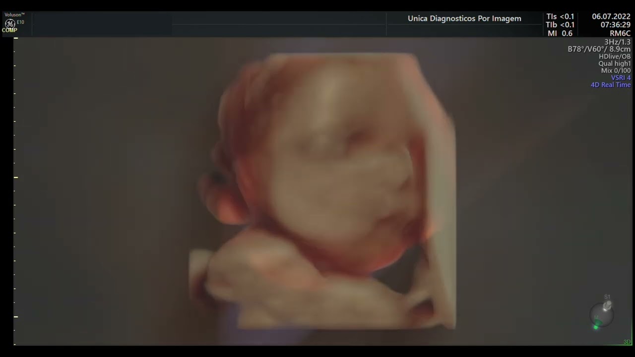 Ultrassom 4D HD Live - 08