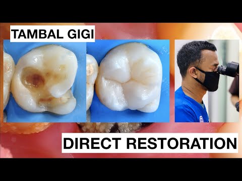 Step by step Dental Filling Composite Molar Direct Restoration