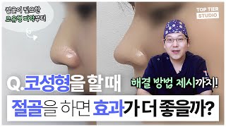 내 코도 절골이 필요할까? 코 수술 전 꼭 알아야 하는 TIP! #절골술 #코성형ㅣ탑티어성형외과