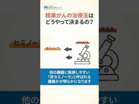 精巣がんについて詳しく解説