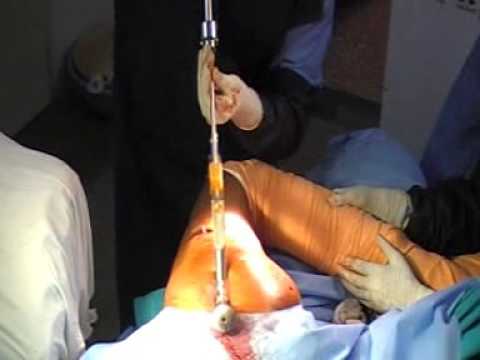 Sub Trochanteric Fracture Nailing on Simple table - OrthoTV