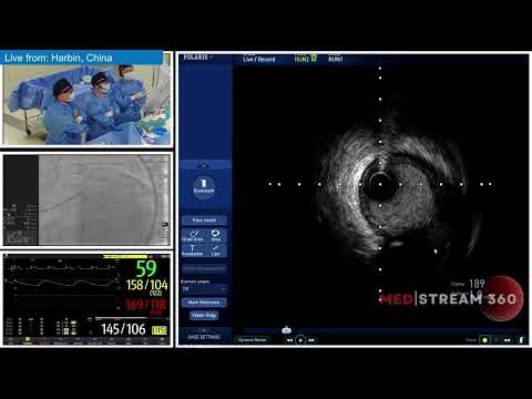 Treatment of IS-CTO With Anchor-Knuckle Technique