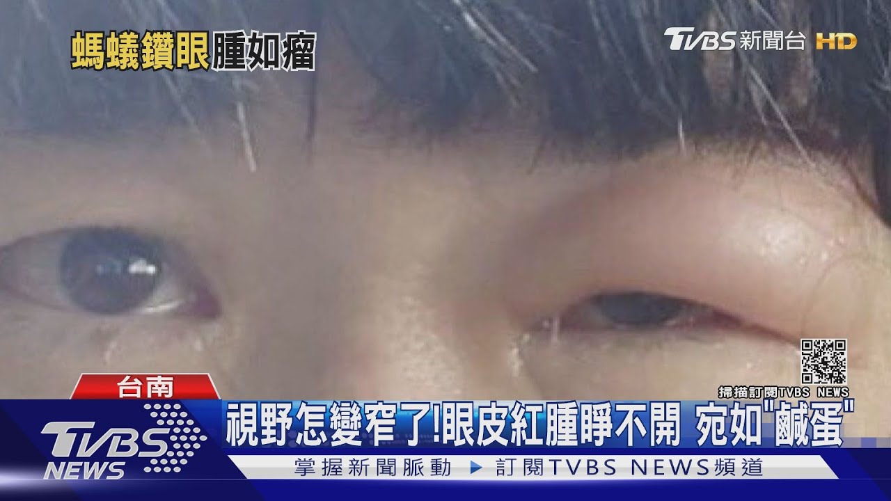 夏天螞蟻多！小螞蟻偷鑽進眼睛　一覺醒來腫成「豬頭」