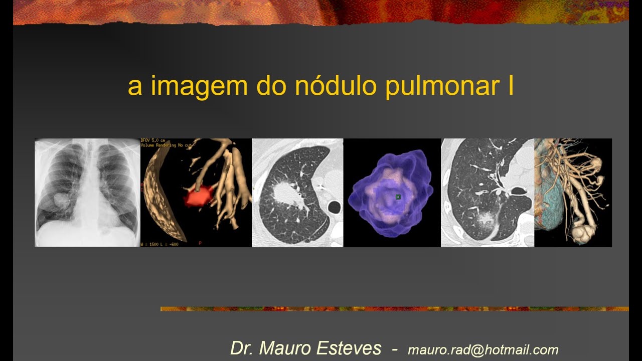 Nódulo pulmonar I