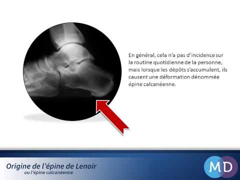 comment soigner epine calcaneenne