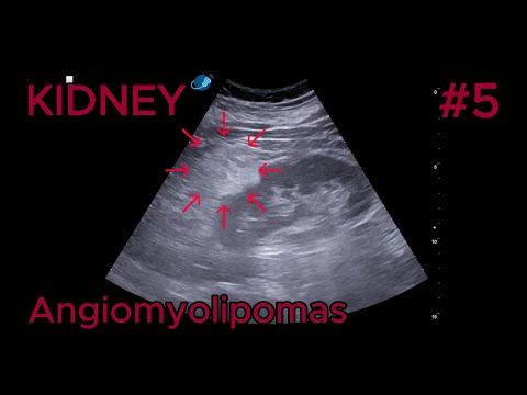 Renal angiomyolipomas video preview