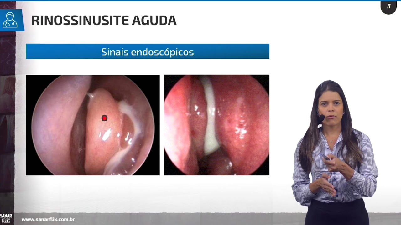 Rinite e Sinusite - Aula de Otorrinolaringologia SanarFlix