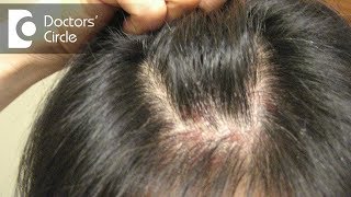 How can one manage recurrence of Scalp Psoriasis? - Dr. Rasya Dixit