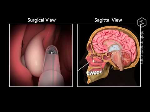 Nasal Polyp Removal