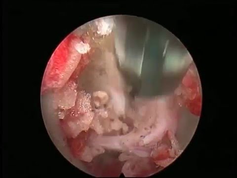 Wie die Rückseite mit Osteochondrose massieren Ich mache ein MRI des Knies