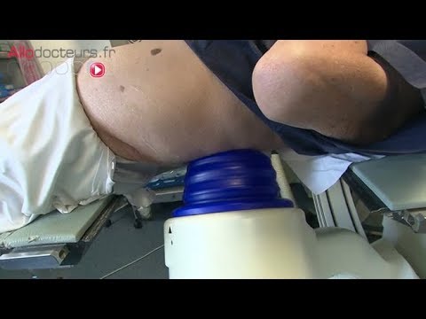 Une onde de choc pour détruire les calculs rénaux - Allô Docteurs