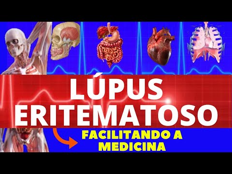 LÚPUS ERITEMATOSO - O QUE É, CAUSAS E SINTOMAS - TUDO SOBRE LÚPUS ERITEMATOSO - REUMATOLOGIA