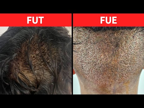 FUE or FUT : Know This Before Choosing