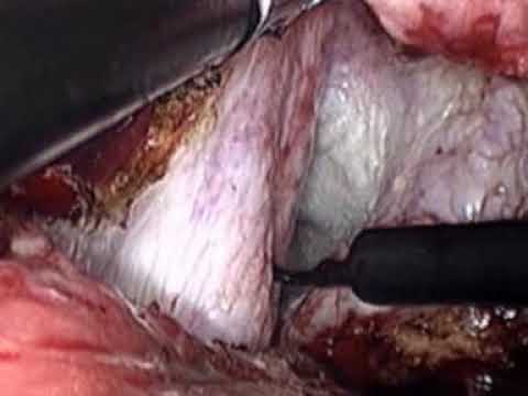 LAPAROSCOPIC  LIVER RESECTION FOR HYDATID CYST