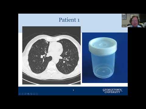 Update on Bronchiectasis Treatments Including new Investigational Therapies