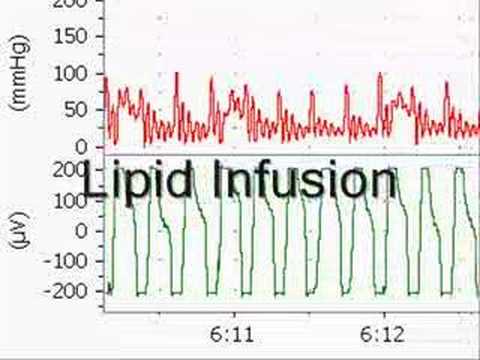 Intralipid – myth or miracle? • LITFL • CCC