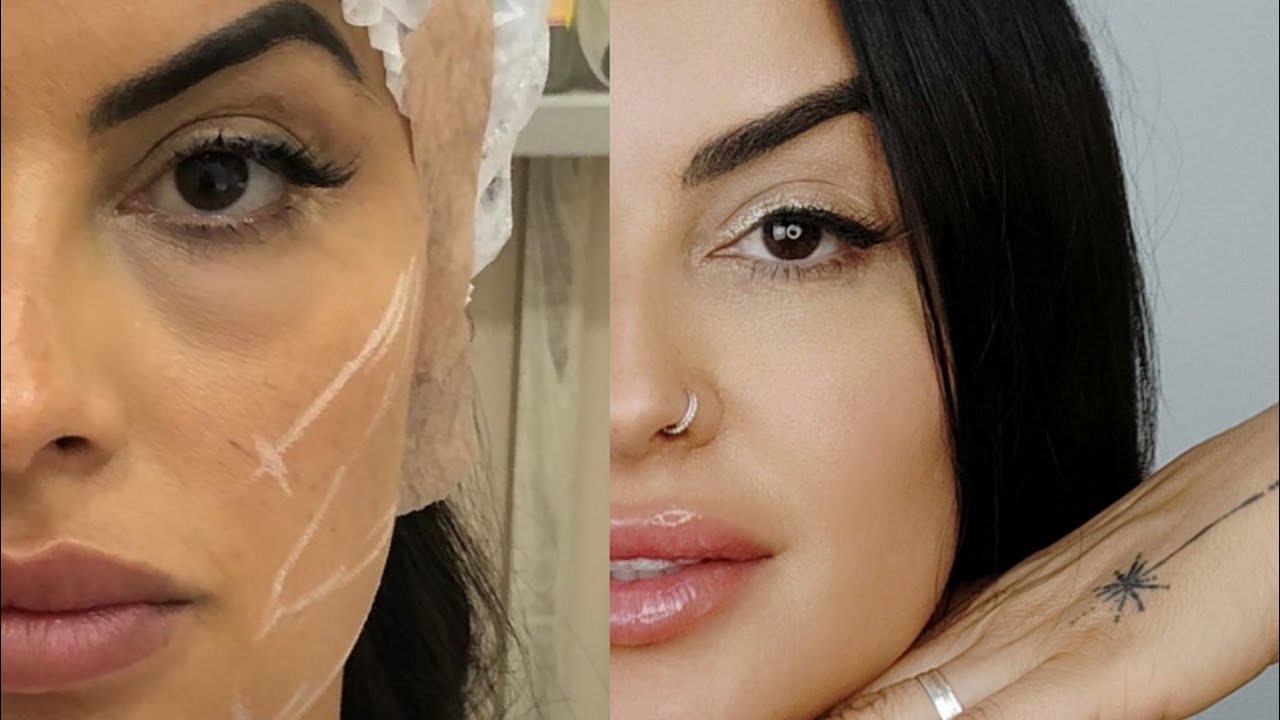 Aplicação + antes e depois FIOS de PDO garra!