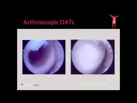 Artroskopia stawu kolanowego OATS