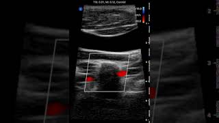 Antegrade Vertebral Artery: Butterfly iQ Clinical Image