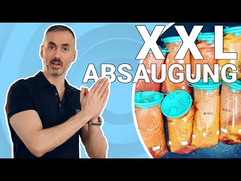 Your Plastic Surgery Coach - Opportunities and risks of XXL liposuction - Mega Liposuction