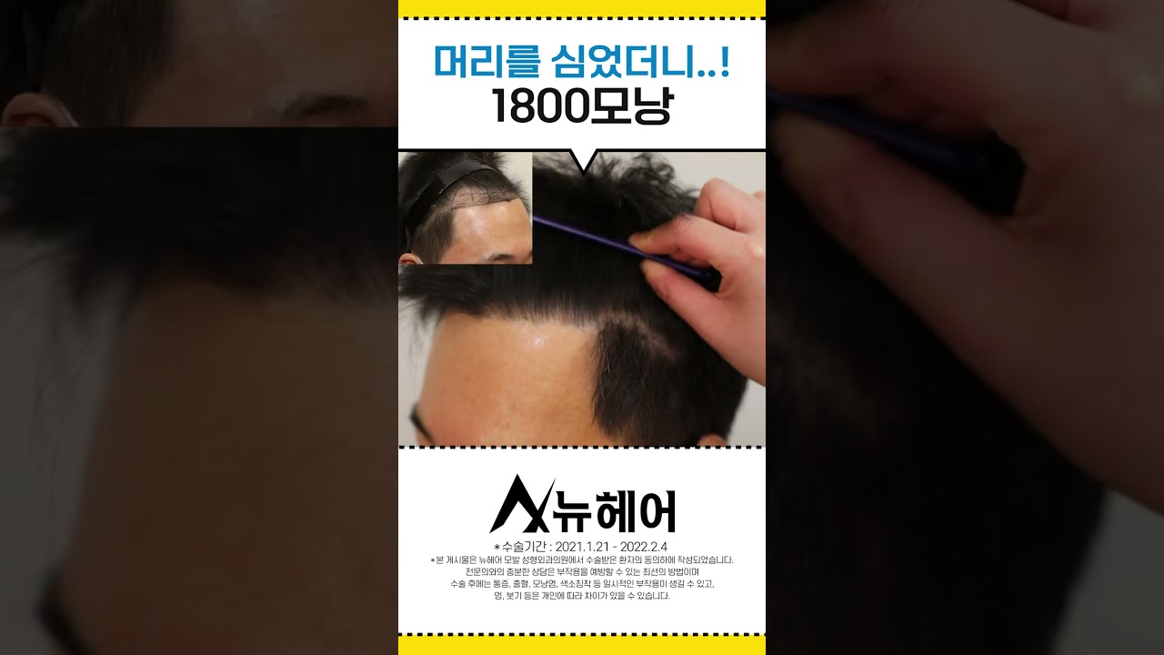宽额男子！ 植发毛发移植 1年后期 ㅣ1800 毛囊 ㅣ New Hair