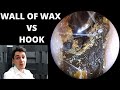 Great Wall Of Ear Wax VS Metal Hook