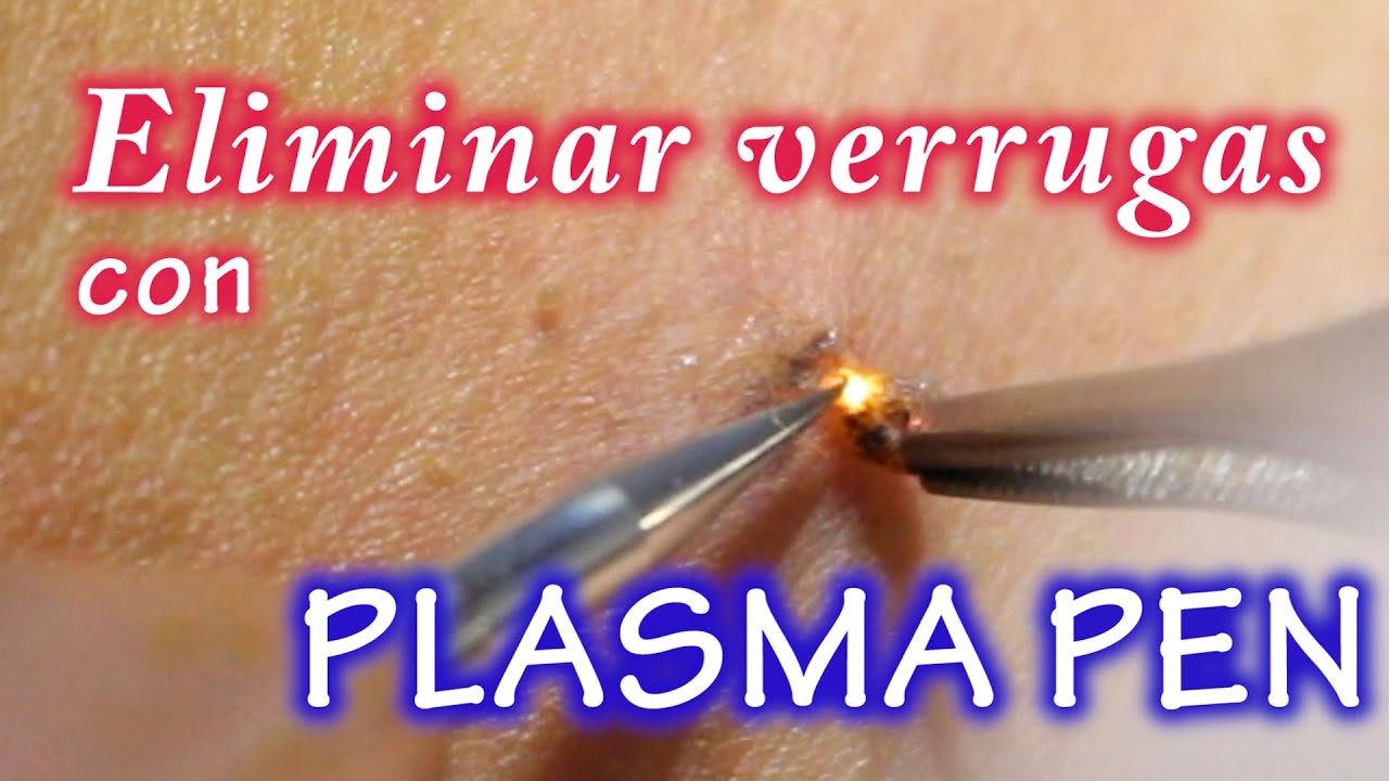 ELIMINANDO VERRUGAS CON PLASMA PEN