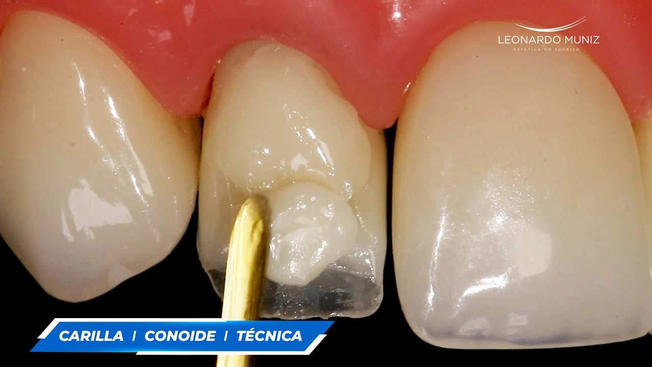 CARILLA DIRECTA EN INCISIVO LATERAL CONOIDE: TÉCNICA