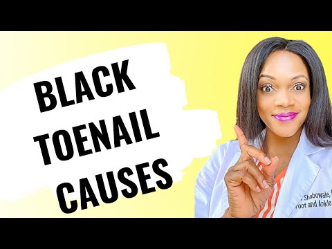 black toenail causes/causes of black toenail