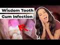 what does this SWOLLEN gum flap mean? (Pericoronitis Explained)