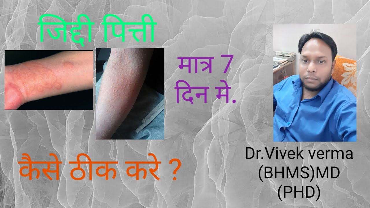 Watch video पित्ती,खुजली, जलन | Charak pharma urtiplex capsule for urticaria | By Dr.Vivek verma homoeopath Now पित्ती,खुजली, जलन | Charak pharma urtiplex capsule for urticaria | By Dr.Vivek verma homoeopath