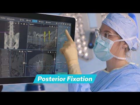 Excelsius® Lateral 360 Posterior Fixation
