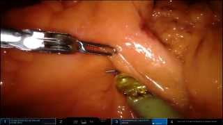 Download Lagu Robotic Ascending Colectomy with Intracorporeal Anastomosis Thumbnail