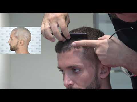 Manual FUE Hair Transplant Before & After, 2300 Grafts Result - ASMED - Dr. Koray Erdogan