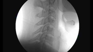 Cervical Spine Video Fluoroscopy - Chiropractic Care