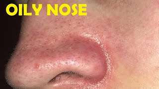how to get rid of oily nose male