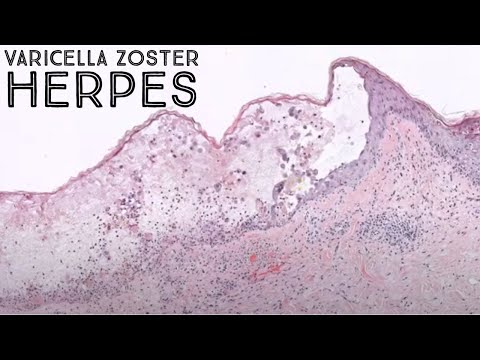 Shingles under the microscope (Varicella Zoster Herpes virus Chickenpox VZV pathology dermatology)
