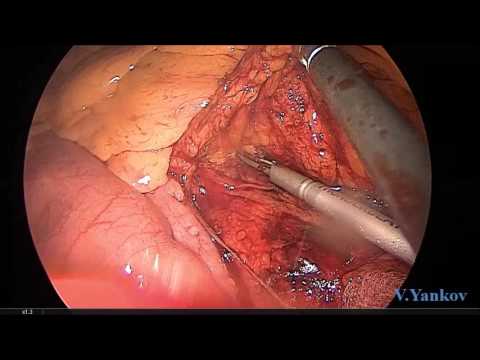 Laparoscopic Low Rectal Resection