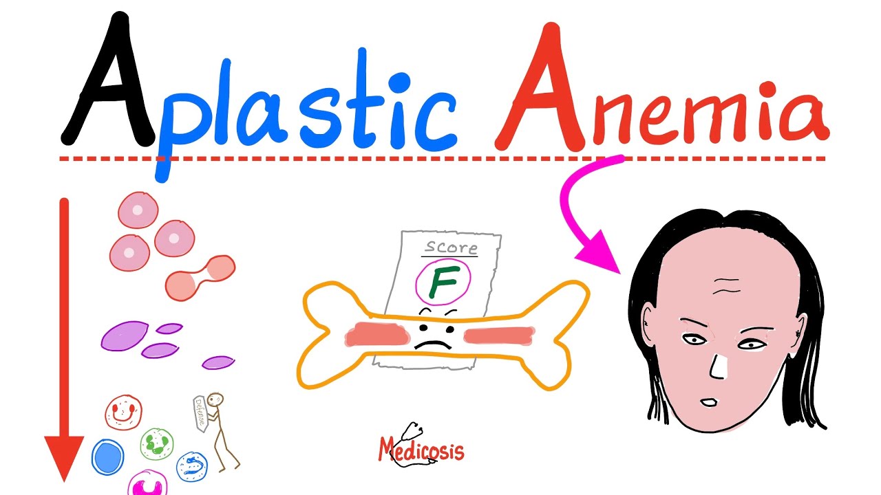 Apa Yang Dimaksud Anemia Aplastic