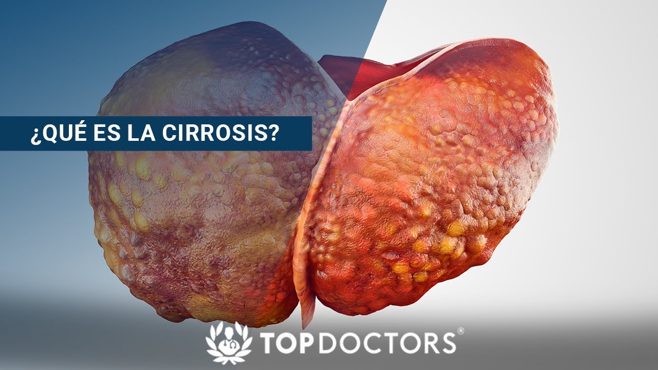 ¿Qué es la Cirrosis